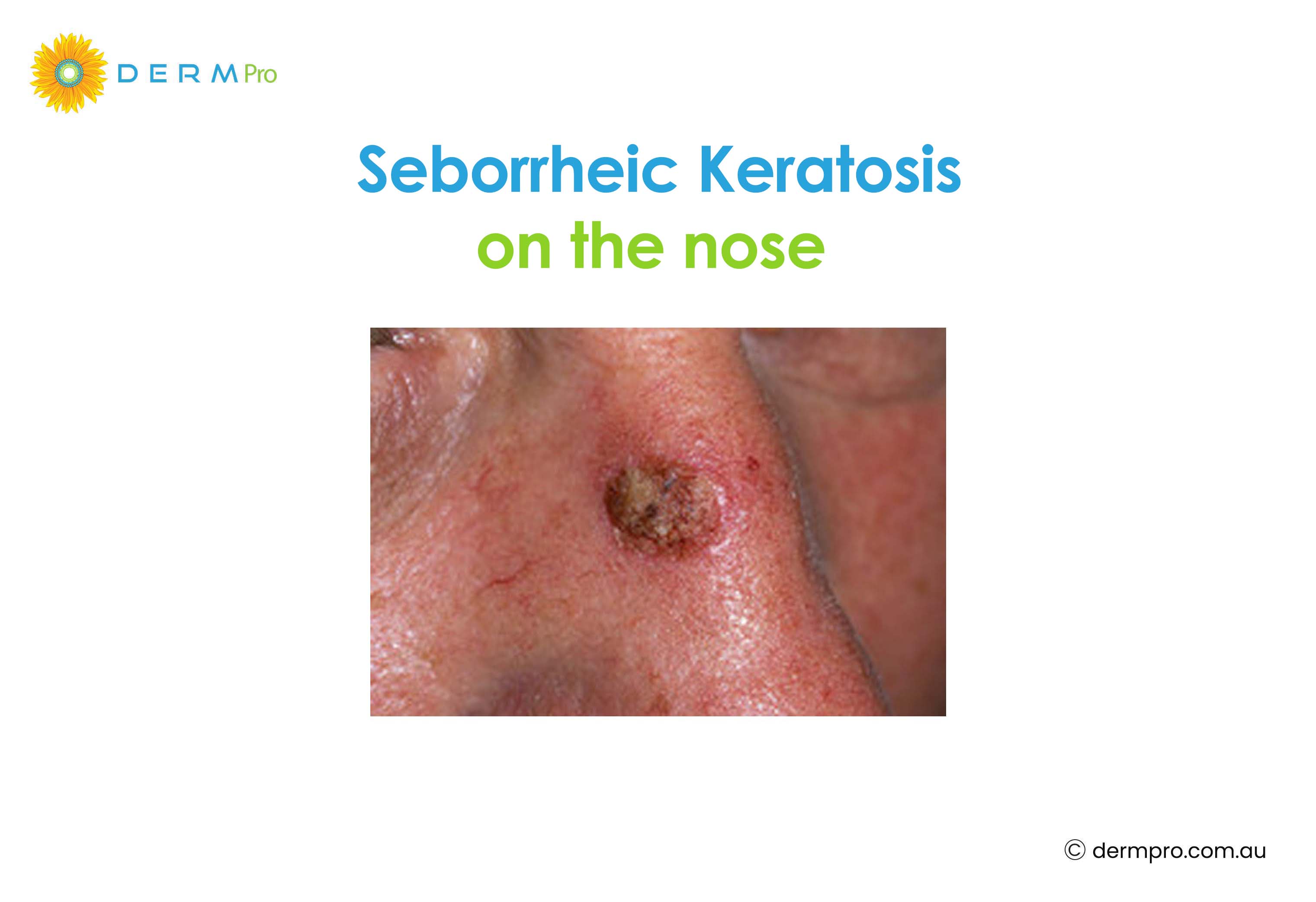 Seborrheic Keratosis on the Nose 